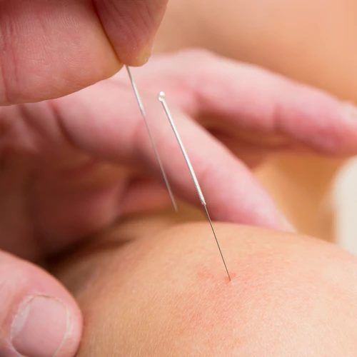 Physiotherapy Brampton ON Acupuncture